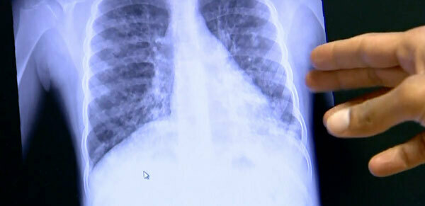 X-ray of lungs with cystic fibrosis. You can see a mass in the lower left side of the lung.